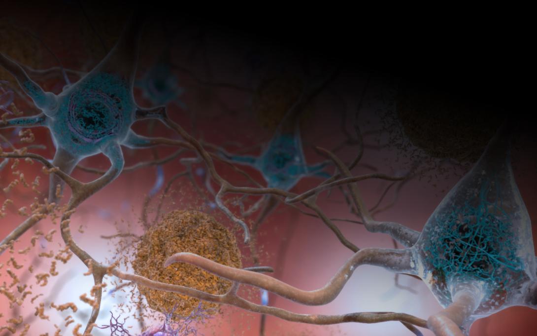 Alzheimer gene variant image